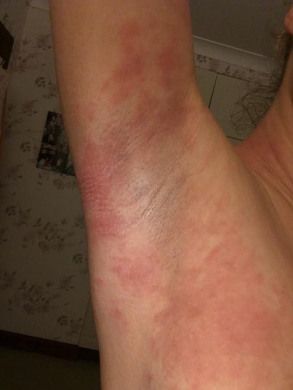 Applied Kinesiology Acupuncture and eczema Sal March