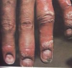 finger psoriasis