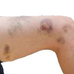 bruised-skin