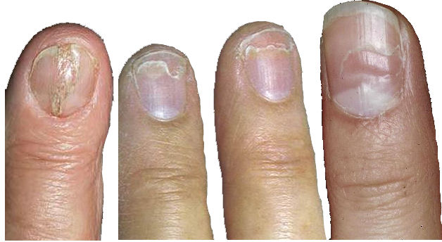 Finger nail fungal infection progression
