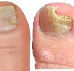 toe nail fungal infection