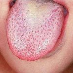 tongue fungal infection