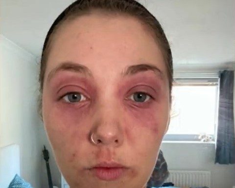 Can Eczema, Psoriasis be caused by diet?